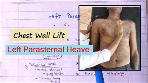 right ventricular heave meaning.